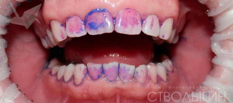 Индикация очагов скопления бактерий Индикация очагов скопления бактерий