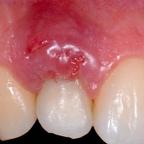 Лечение десен Лечение десен