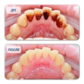Профессиональная гигиена полости рта Профессиональная гигиена полости рта