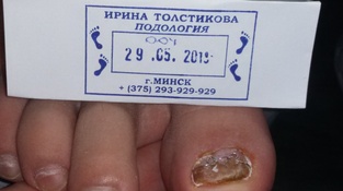 титановая нить