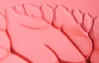 Почему возникает диабетическая язва?