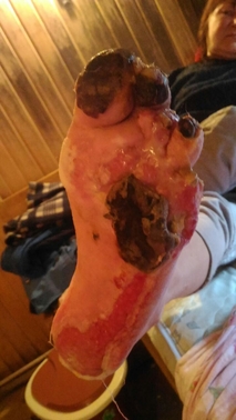 gangrena diabetică a piciorului