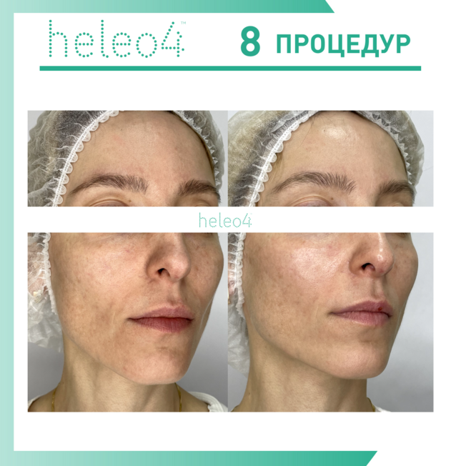 Фотодинамическая терапия HELEO4 в спа-салоне Perfect People