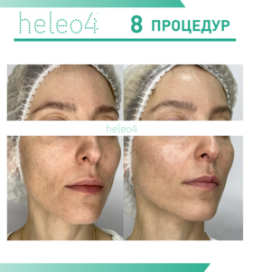 Фотодинамическая терапия HELEO4 в спа-салоне Perfect People