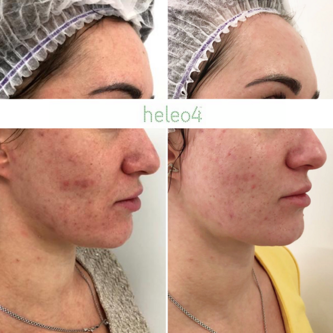Фотодинамическая терапия HELEO4 в спа-салоне Perfect People