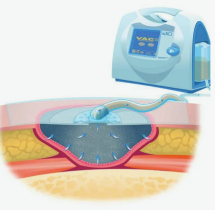 NPWT (VAC‑терапия) для лечения гангрены