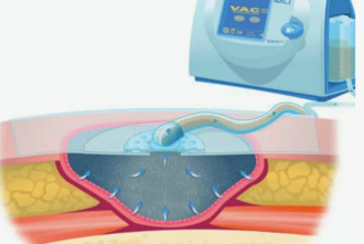 NPWT (VAC‑терапия) для лечения гангрены