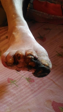 gangrena diabetică a piciorului