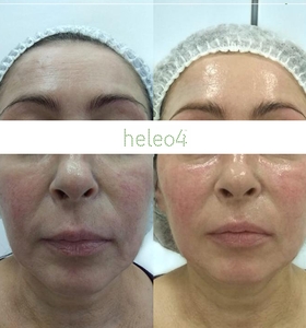 Фотодинамическая терапия HELEO4 в спа-салоне Perfect People