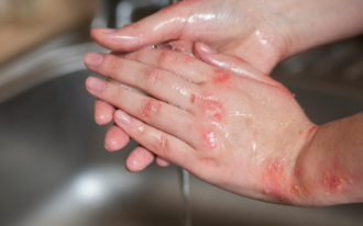 Разновидности ожогов по степени