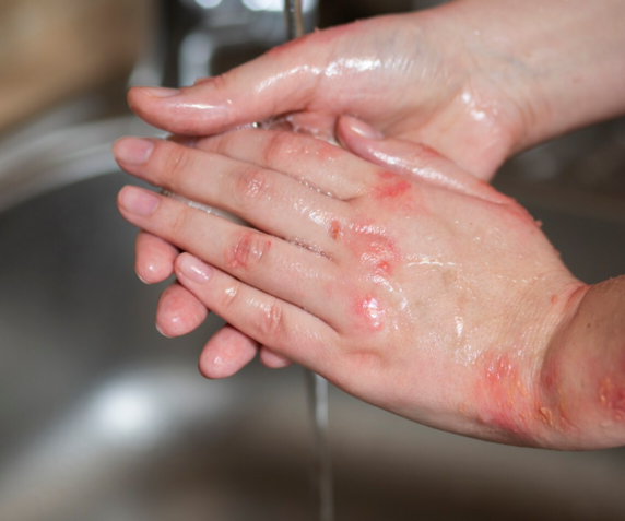 Разновидности ожогов по степени