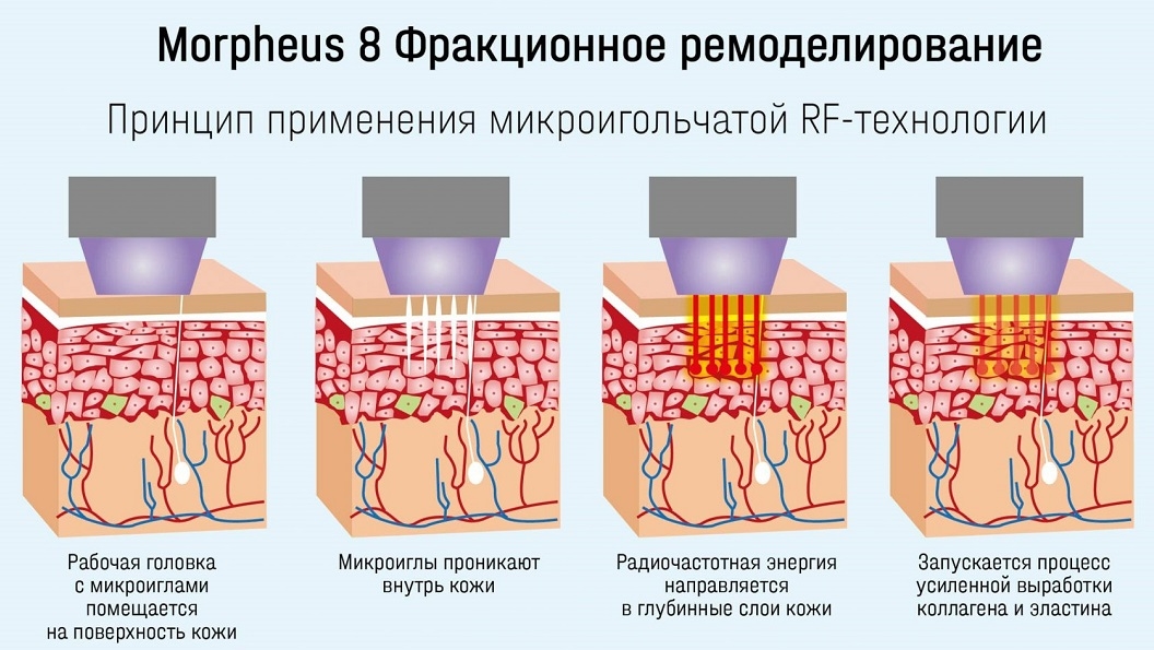 SMAS-лифтинг в спа-салоне Perfect People