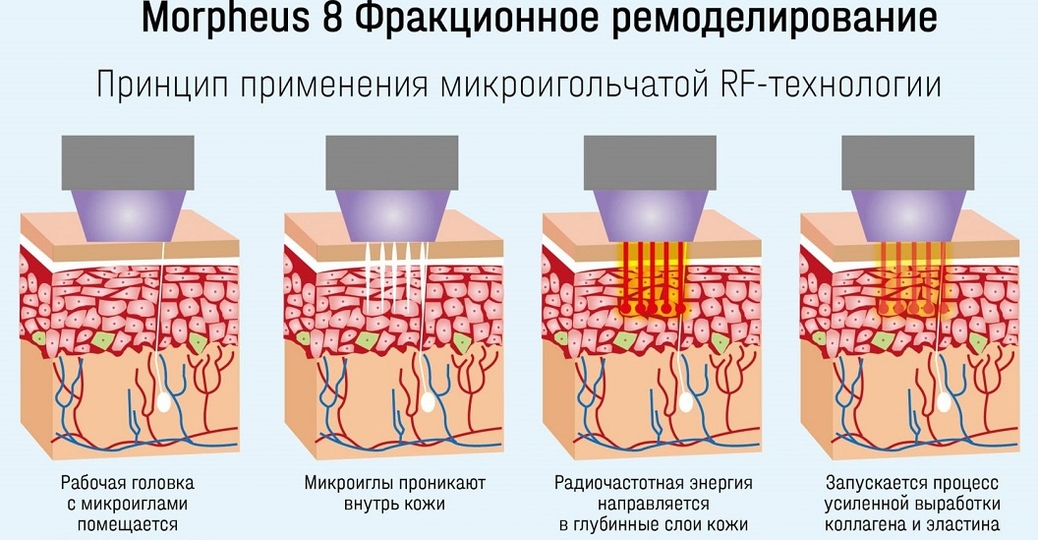 SMAS-лифтинг в спа-салоне Perfect People