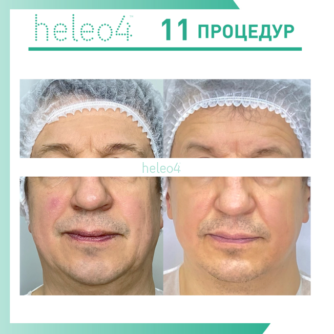 Фотодинамическая терапия HELEO4 в спа-салоне Perfect People