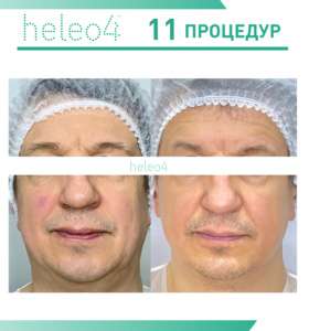 Фотодинамическая терапия HELEO4 в спа-салоне Perfect People