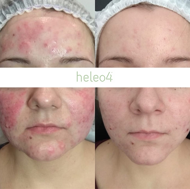 Фотодинамическая терапия HELEO4 в спа-салоне Perfect People