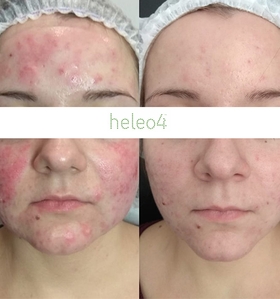 Фотодинамическая терапия HELEO4 в спа-салоне Perfect People