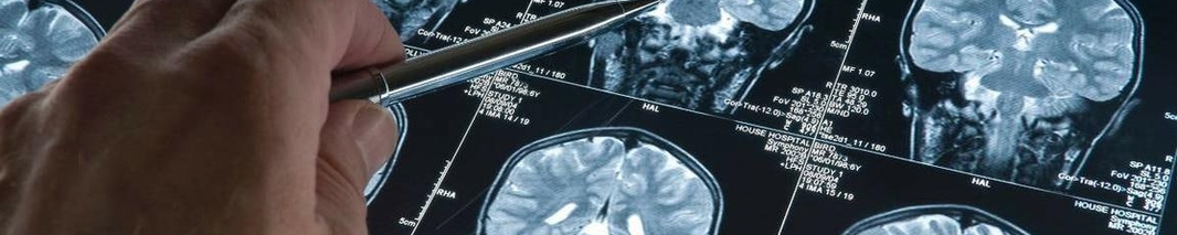 Можно ли курить при эпилепсии? Рекомендации для пациентов с эпилепсией