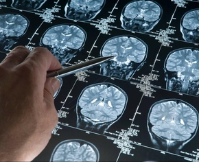 Можно ли курить при эпилепсии? Рекомендации для пациентов с эпилепсией