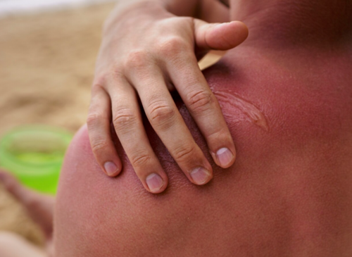 Мази для лечения ожога