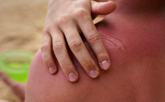 Мази для лечения ожога