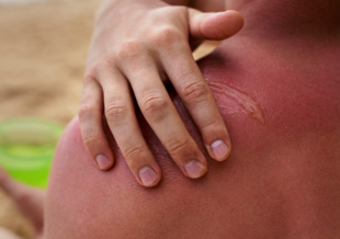 Лечение ожога