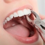 Удаление зубов