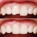 Реставрация зубов