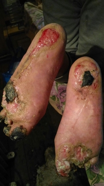 gangrena diabetică a piciorului