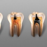 Лечение кариеса