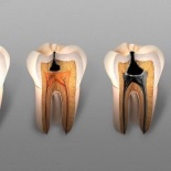 Лечение кариеса