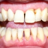 Лечение породонтита