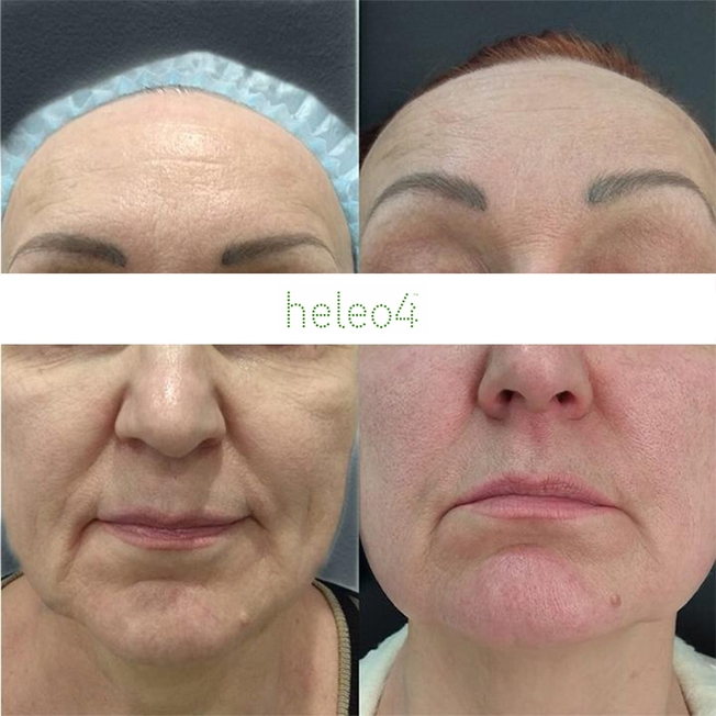 Фотодинамическая терапия HELEO4 в спа-салоне Perfect People
