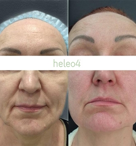 Фотодинамическая терапия HELEO4 в спа-салоне Perfect People