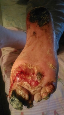 gangrena diabetică a piciorului