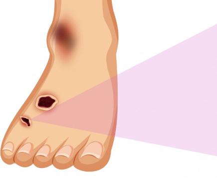 Лечение пролежней на первой стадии