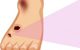 Лечение пролежней на первой стадии