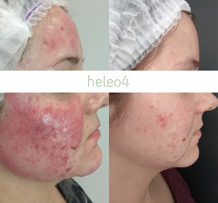 Фотодинамическая терапия HELEO4 в спа-салоне Perfect People