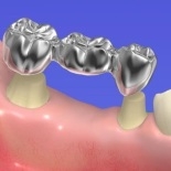 Мостовидные зубные протезы