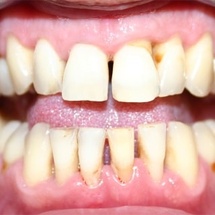 Лечение пародонтита