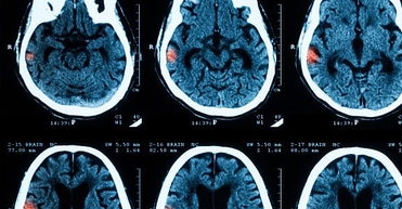 МРТ головного мозга при эпилептических синдромах