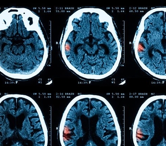 эпилепсия диагностика лечение