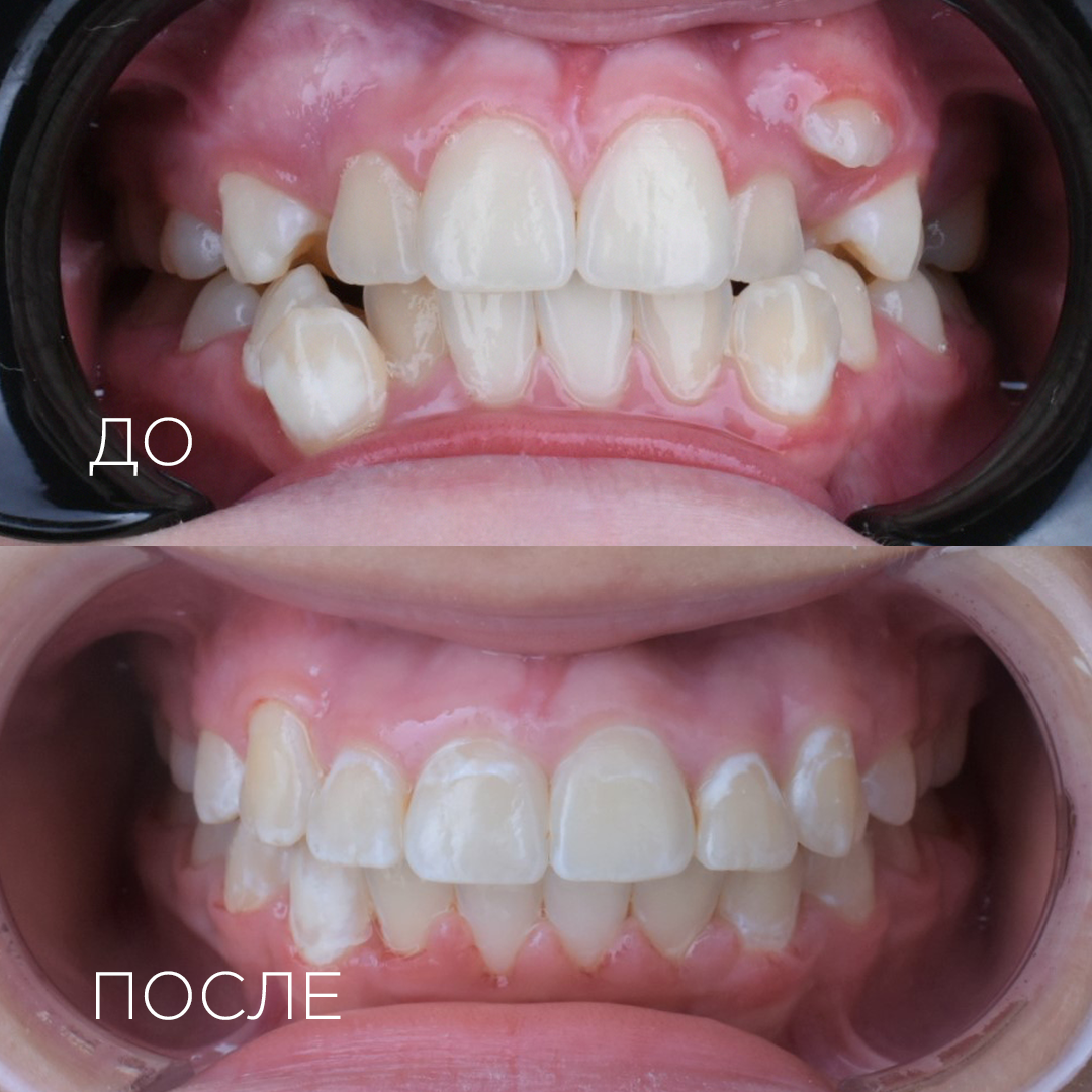прикус до/после