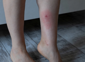 Причины трофических язв