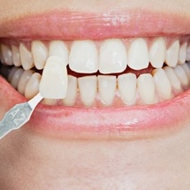 Несъёмные зубные протезы: виниры