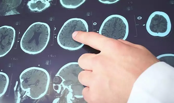 Как курение влияет на частоту эпилептических приступов