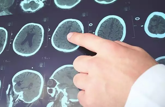 Как курение влияет на частоту эпилептических приступов