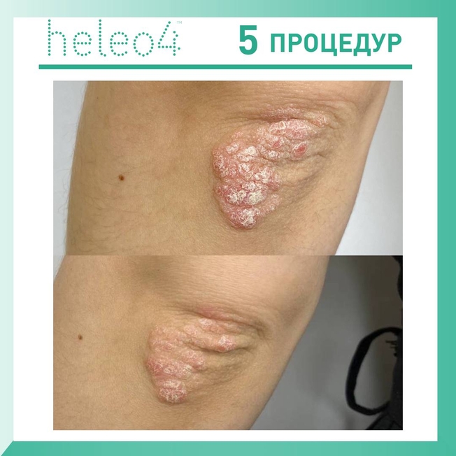 Фотодинамическая терапия HELEO4 в спа-салоне Perfect People