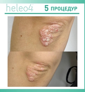Фотодинамическая терапия HELEO4 в спа-салоне Perfect People