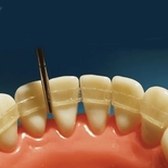 Шинирование подвижных ​зубов